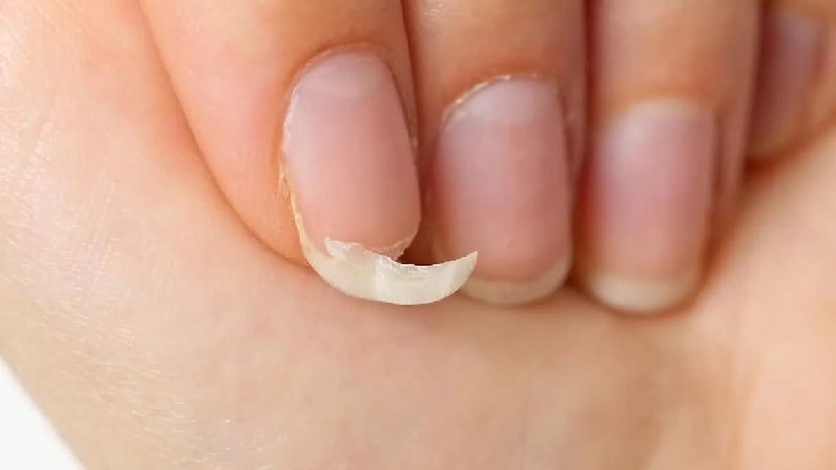 Czy złamany paznokieć się zrośnie? Sprawdź, co musisz wiedzieć Czy złamany paznokieć się zrośnie? Sprawdź, co musisz wiedzieć