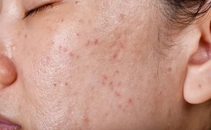 Jak skutecznie walczyć z tłustą cerą i poprawić wygląd skóry Jak skutecznie walczyć z tłustą cerą i poprawić wygląd skóry