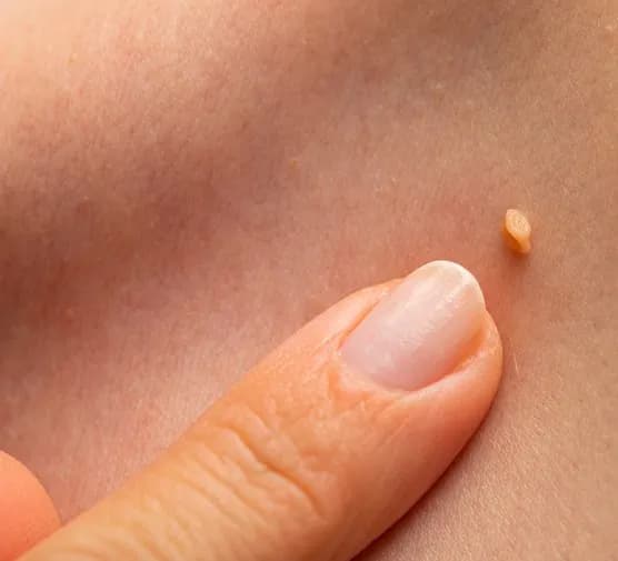 Zadziory przy paznokciach: jakie witaminy pomogą je zlikwidować? Zadziory przy paznokciach: jakie witaminy pomogą je zlikwidować?